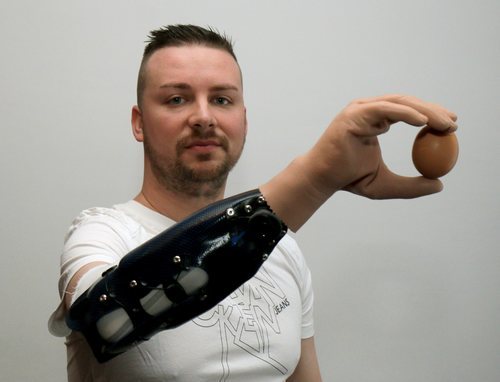 La tecnología ya ayuda a la medicina actualmente. Es el caso de Milorad Marinkovic, quien sufrió un accidente que le costó el antebrazo derecho y que ahora posee una prótesis biónica que le ayuda con su día a día.